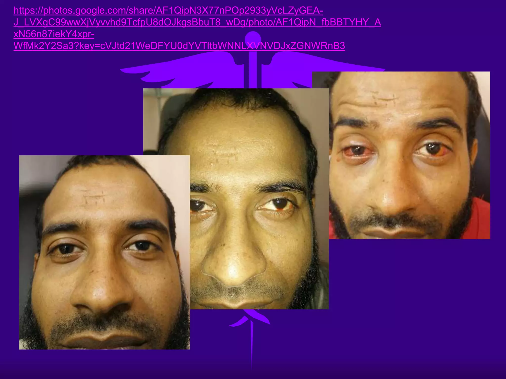 • the cosmetic improvement is (85 -95%).
• the binocular vision is improved in young
children 45%??.
• all the patients showed improvement, and no
permanent double vision.
Conclusion
dr.jamal19@gmail.com
 