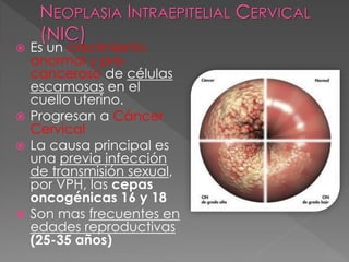    Es un crecimiento
    anormal y pre-
    canceroso de células
    escamosas en el
    cuello uterino.
   Progresan a Cáncer
    Cervical
   La causa principal es
    una previa infección
    de transmisión sexual,
    por VPH, las cepas
    oncogénicas 16 y 18
   Son mas frecuentes en
    edades reproductivas
    (25-35 años)
 