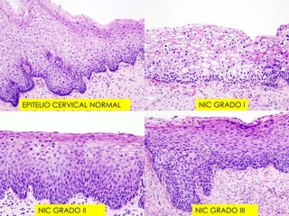 EPITELIO CERVICAL NORMAL   NIC GRADO I




   NIC GRADO II            NIC GRADO III
 