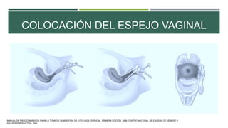 COLOCACIÓN DEL ESPEJO VAGINAL
MANUAL DE PROCEDIMIENTOS PARA LA TOMA DE LA MUESTRA DE CITOLOGÍA CERVICAL. PRIMERA EDICIÓN. 2006. CENTRO NACIONAL DE EQUIDAD DE GÉNERO Y
SALUD REPRODUCTIVA. SSA.
 