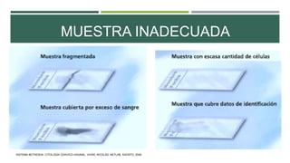 MUESTRA INADECUADA
SISTEMA BETHESDA: CITOLOGÍA CERVICO-VAGINAL. VIVAR, NICOLÁS. NETLAB. AGOSTO, 2006.
 