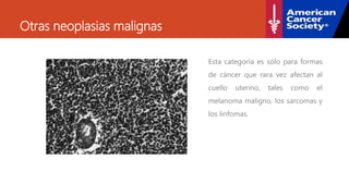 Otras neoplasias malignas
Esta categoría es sólo para formas
de cáncer que rara vez afectan al
cuello uterino, tales como el
melanoma maligno, los sarcomas y
los linfomas.
 
