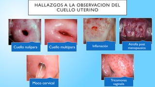 •
HALLAZGOS A LA OBSERVACION DEL
CUELLO UTERINO
Cuello nulípara Cuello multipara
Moco cervical
Inflamación
Atrofia post
menopausica
Tricomonas
vaginalis
 