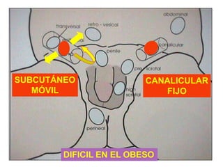 SUBCUTÁNEO
MÓVIL
CANALICULAR
FIJO
DIFICIL EN EL OBESO
 