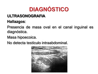 ULTRASONOGRAFIA
Hallazgos:
Presencia de masa oval en el canal inguinal es
diagnóstica.
Masa hipoecoica.
No detecta testículo intraabdominal.
 