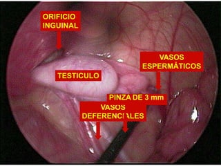 TESTICULO
ORIFICIO
INGUINAL
VASOS
ESPERMÁTICOS
VASOS
DEFERENCIALES
PINZA DE 3 mm
 