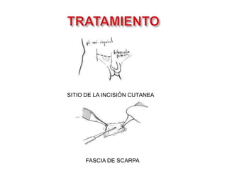 SITIO DE LA INCISIÓN CUTANEA
FASCIA DE SCARPA
 