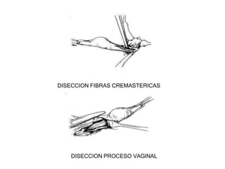 DISECCION FIBRAS CREMASTERICAS
DISECCION PROCESO VAGINAL
 