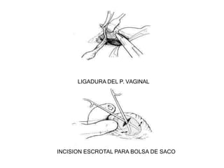 LIGADURA DEL P. VAGINAL
INCISION ESCROTAL PARA BOLSA DE SACO
 