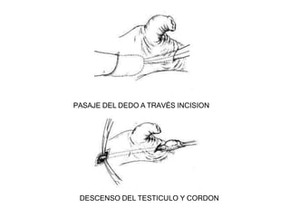 PASAJE DEL DEDO A TRAVÉS INCISION
DESCENSO DEL TESTICULO Y CORDON
 