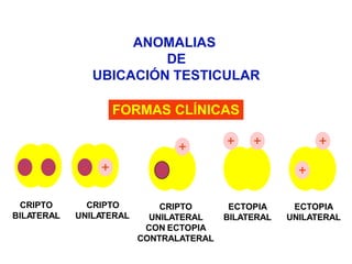 ANOMALIAS
DE
UBICACIÓN TESTICULAR
- -
CRIPTO
BILA
TERAL
- +
CRIPTO
UNILA
TERAL
-
+
CRIPTO
UNILATERAL
CON ECTOPIA
CONTRALATERAL
+ +
ECTOPIA
BILATERAL
+
+
ECTOPIA
UNILATERAL
FORMAS CLÍNICAS
 