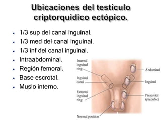  1/3 sup del canal inguinal.
 1/3 med del canal inguinal.
 1/3 inf del canal inguinal.
 Intraabdominal.
 Región femoral.
 Base escrotal.
 Muslo interno.
 
