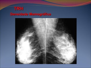 TRH Densidade Mamográfica 
