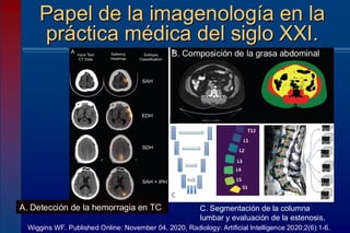 Papel de la imagenología en la
práctica médica del siglo XXI.
Wiggins WF. Published Online: November 04, 2020, Radiology: Artificial Intelligence 2020;2(6):1-6.
B. Composición de la grasa abdominal
A. Detección de la hemorragia en TC C. Segmentación de la columna
lumbar y evaluación de la estenosis.
 