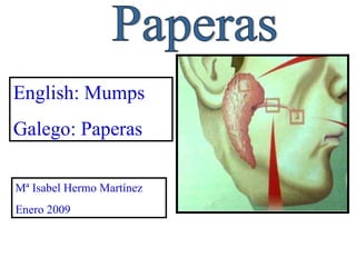 Paperas Mª Isabel Hermo Martínez Enero 2009 English: Mumps Galego: Paperas 