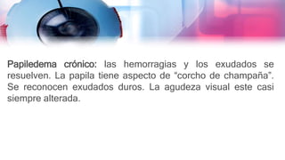 Papiledema crónico: las hemorragias y los exudados se
resuelven. La papila tiene aspecto de “corcho de champaña”.
Se reconocen exudados duros. La agudeza visual este casi
siempre alterada.
 
