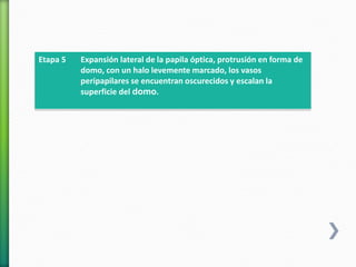 Etapa 5 Expansión lateral de la papila óptica, protrusión en forma de
domo, con un halo levemente marcado, los vasos
peripapilares se encuentran oscurecidos y escalan la
superficie del domo.
 