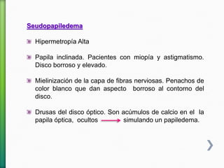 Seudopapiledema
Hipermetropía Alta
Papila inclinada. Pacientes con miopía y astigmatismo.
Disco borroso y elevado.
Mielinización de la capa de fibras nerviosas. Penachos de
color blanco que dan aspecto borroso al contorno del
disco.
Drusas del disco óptico. Son acúmulos de calcio en el la
papila óptica, ocultos simulando un papiledema.
 