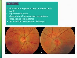 INCIPIENTE
 Borran los márgenes superior e inferior de la
papila
• hiperemia del disco
 desaparece el pulso venoso espontáneo
• dilatación de los capilares
 Se mantiene la excavación fisiológica
 