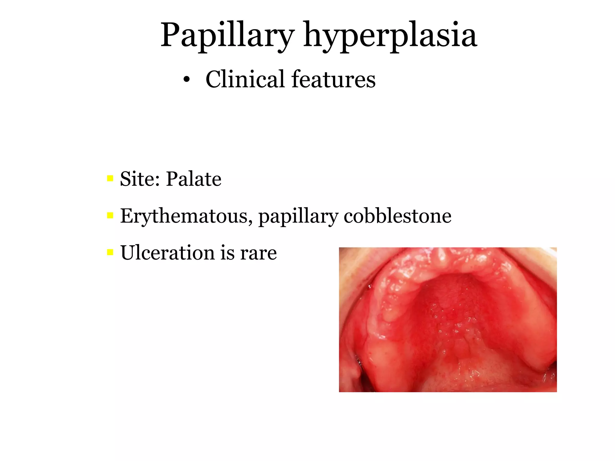 Papillary Dysfunction Papillary lesions | PDF