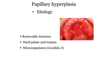 Papillary Dysfunction Papillary lesions | PDF
