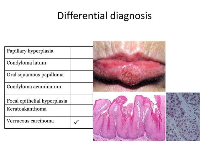 Papillary Dysfunction Papillary lesions | PDF
