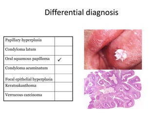 Differential diagnosis
Papillary hyperplasia
Condyloma latum
Oral squamous papilloma
Condyloma acuminatum
Focal epithelial hyperplasia
Keratoakanthoma
Verrucous carcinoma



 