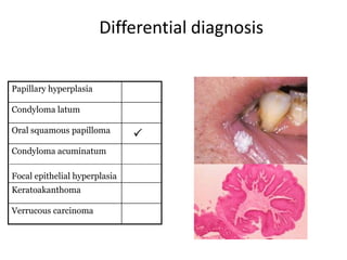 Differential diagnosis
Papillary hyperplasia
Condyloma latum
Oral squamous papilloma
Condyloma acuminatum
Focal epithelial hyperplasia
Keratoakanthoma
Verrucous carcinoma



 