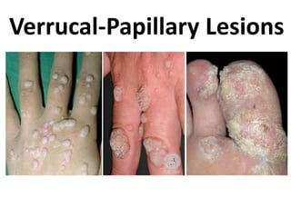Verrucal-Papillary Lesions

 