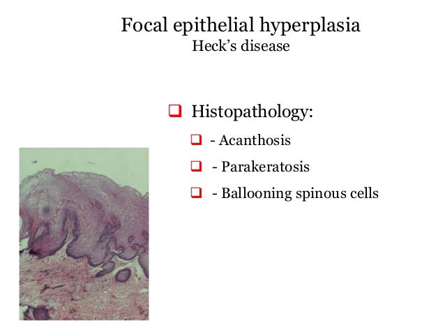 Papillary lesions