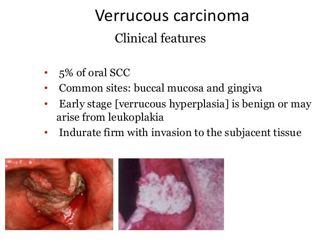 Papillary lesions