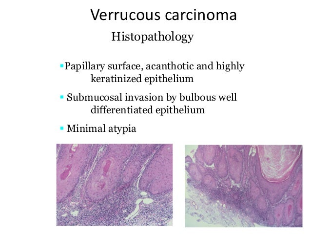 Papillary lesions