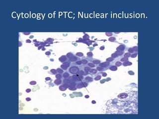 Cytology of PTC; Nuclear inclusion.
 
