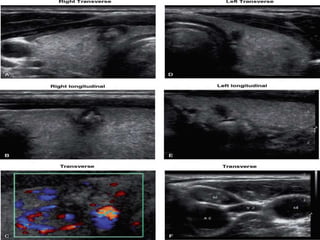 Papillary thyroid cancer 
