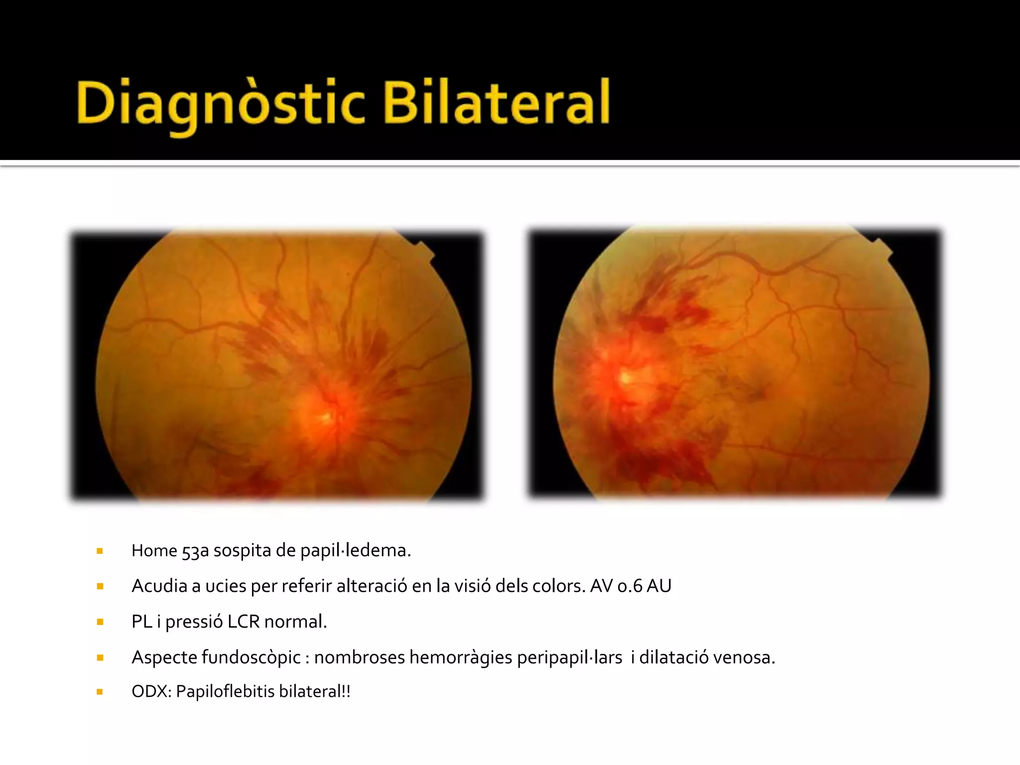 HII	CausesFàrmacsÁc. nalixídic, corticosteroides, hormona de creixement, nitrofurantoïna, liti, tetraciclines i hormones tiroidees.Transtorns vitamínics:Hipervitaminosis A, hipovitaminosis A i D.IntoxicacionsPlom.Malalties sistèmiques:EPOC, SAHS, urèmia, anèmia severa, malaltia Addison, hipoparattiroidisme, malaltia de Behçet, lupus E.S., sd. Ovari poliquístic i alteracions en la coagulació.