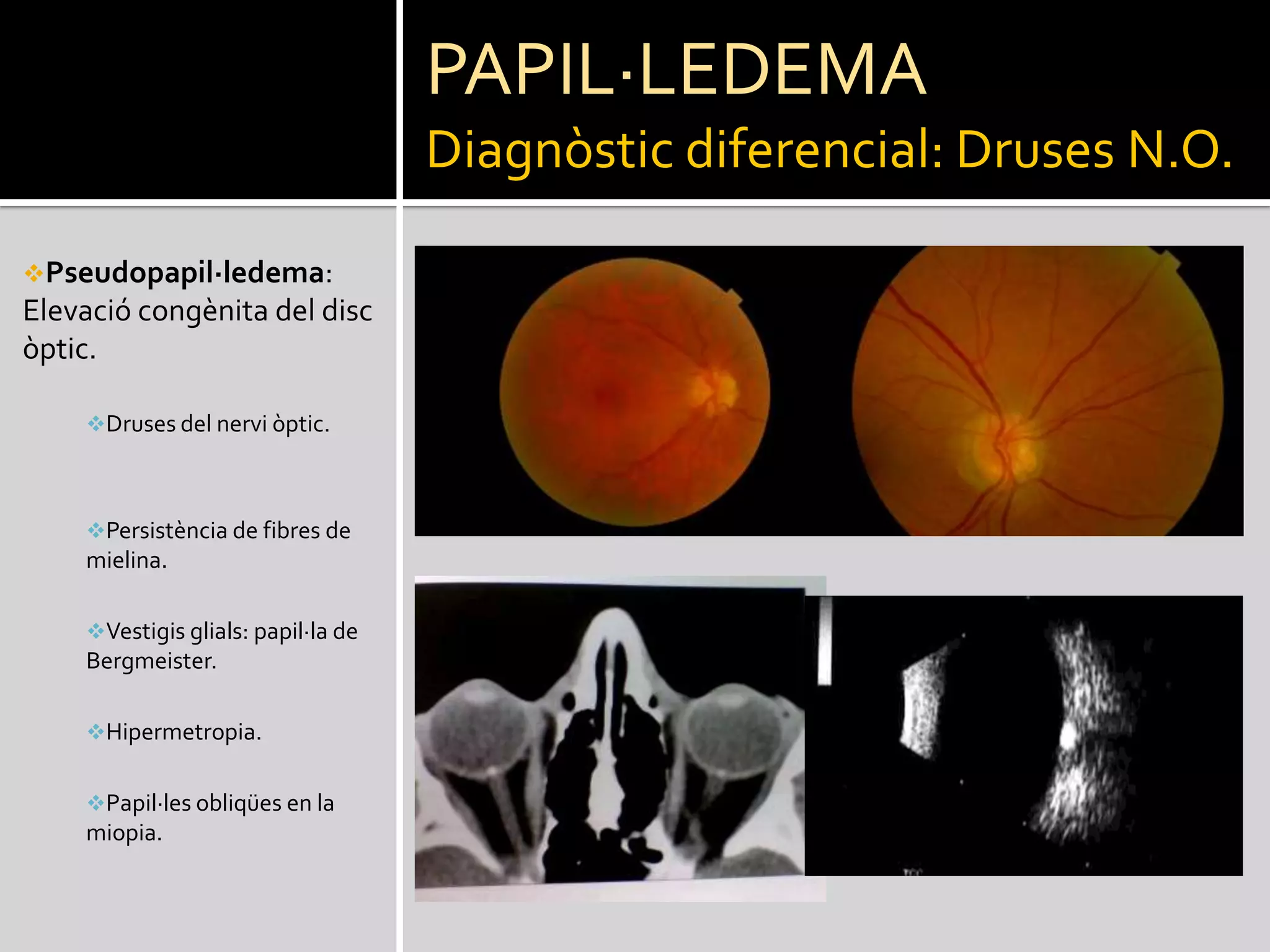 HII	FisiopatologiaVitamina A:Nivells elevats de Retinol lliure i nivells baixos de RBP(retinol bindingprotein) en LCR1.Factors contribuents:Obesitat incrementa la pressió intrabdominaldisminuïnt el retorn venós.Hipercàpnia en el SAHOS produeix vasodilatació augmentant el contingut cerebral.Secreció de Leptina i altres hormones per part del teixit adipós.Estenosi sins venosos:En un estudi2 s’ha demostrat alt. venoses en >90% dels pacients amb HII en absència de trombosi.1 Warner J, Larson A et al. Retinol-Binding Protein and Retinol Analysis in Cerebrospinal Fluid and Serum of Patients With andWithoutIdiopathicIntracranialHypertension. J Neuro-Ophthalmol 2007;27:258–2622R.I. Farb, I. Vanek, J.N. Scott et al. Idiopathicintracranialhypertension: theprevalence and morphology of sinovenousstenosis. Neurology 2003; 60-1418.