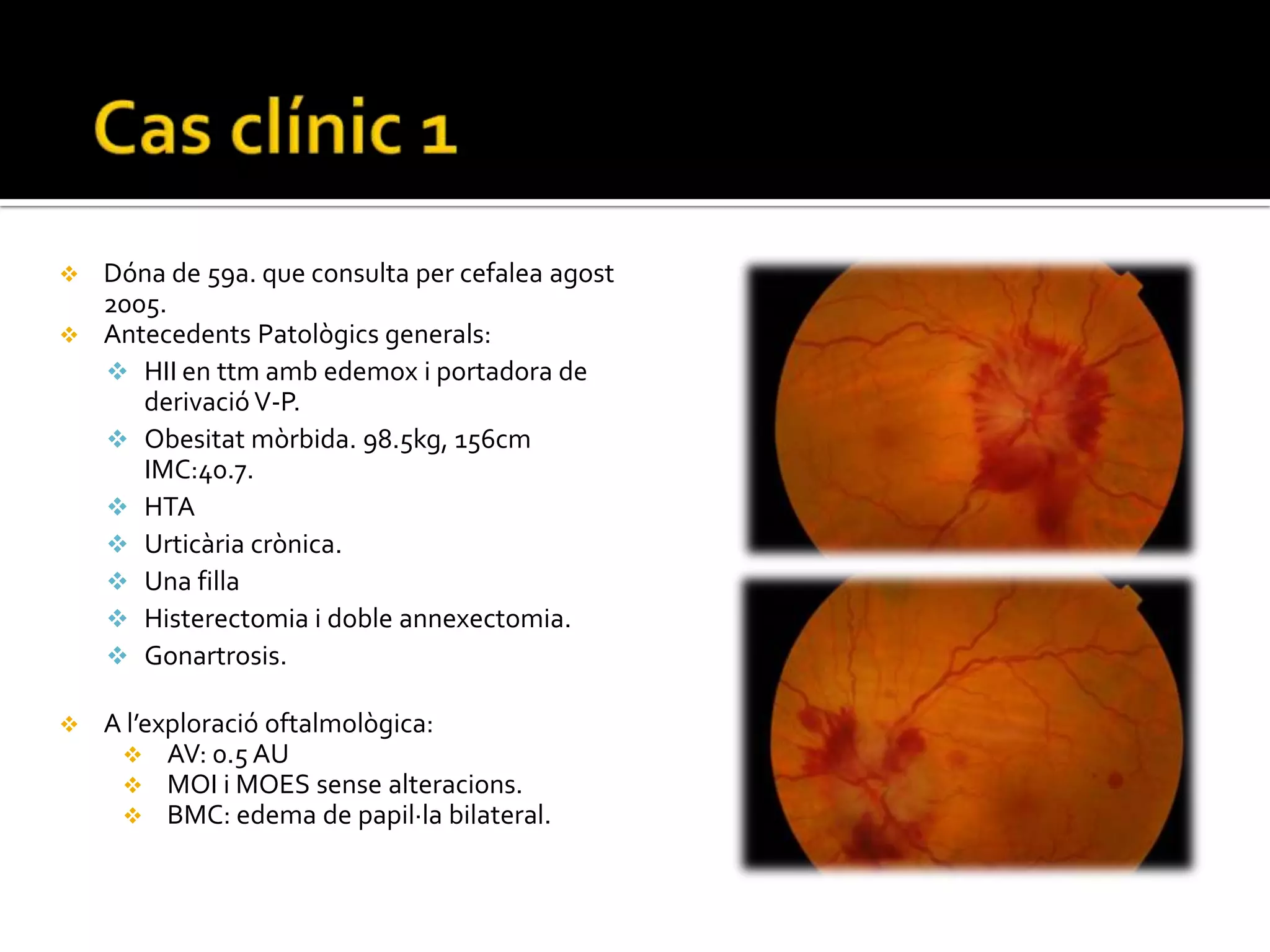 Druses del nervi òptic.