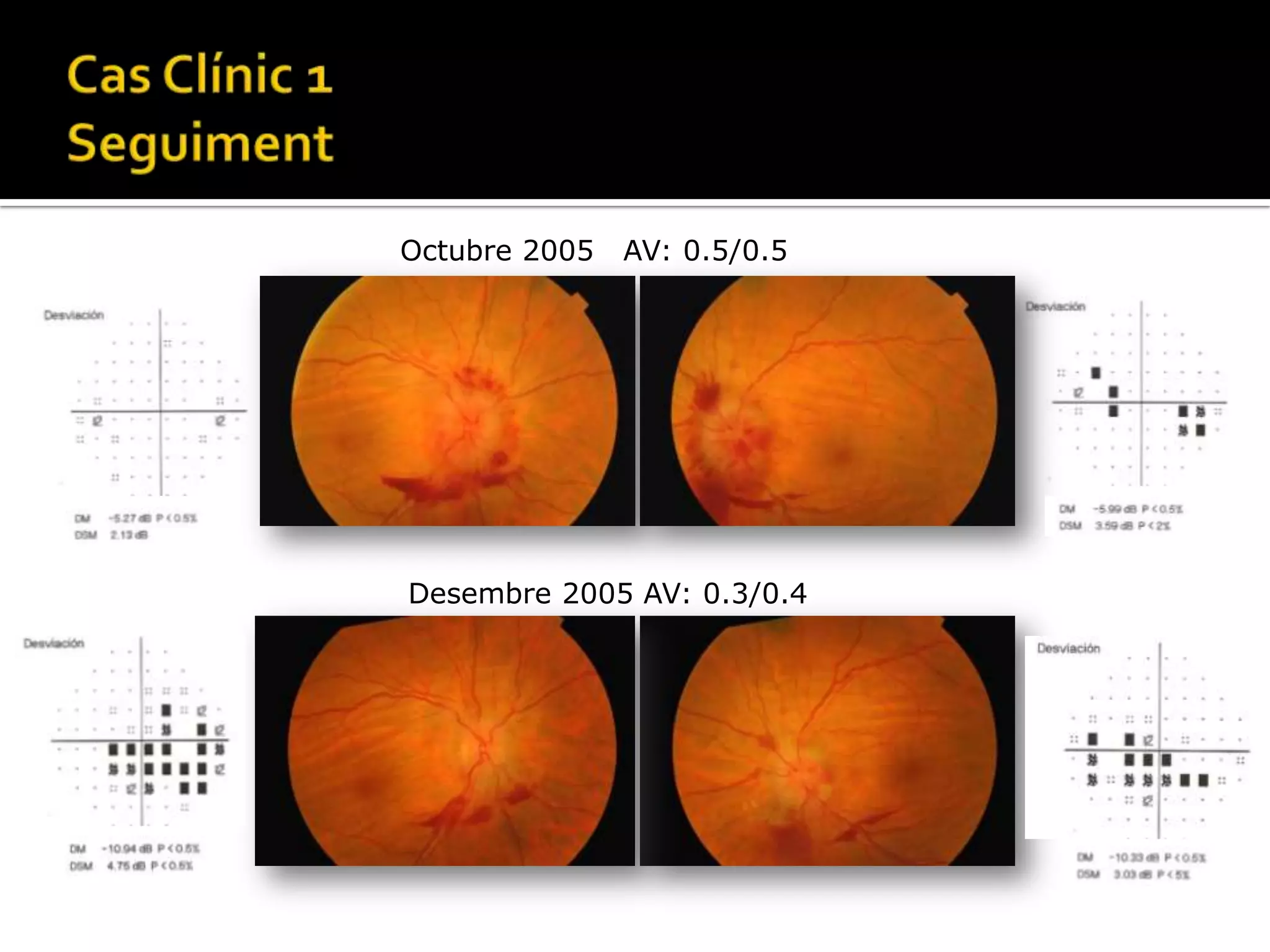 Vestigis glials: papil·la de Bergmeister.