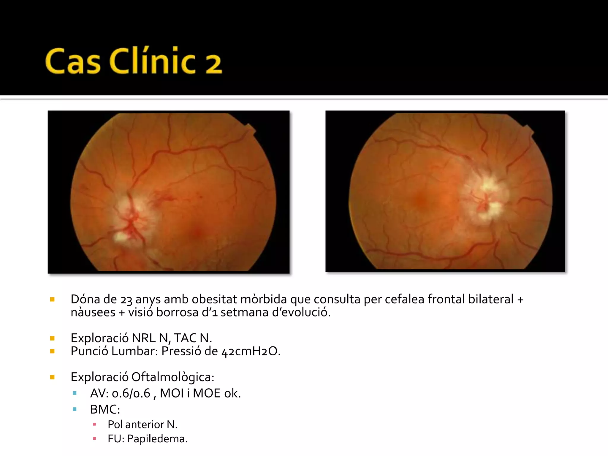 Papil·les obliqües en la miopia.PAPIL·LEDEMADiagnòstic diferencial IV