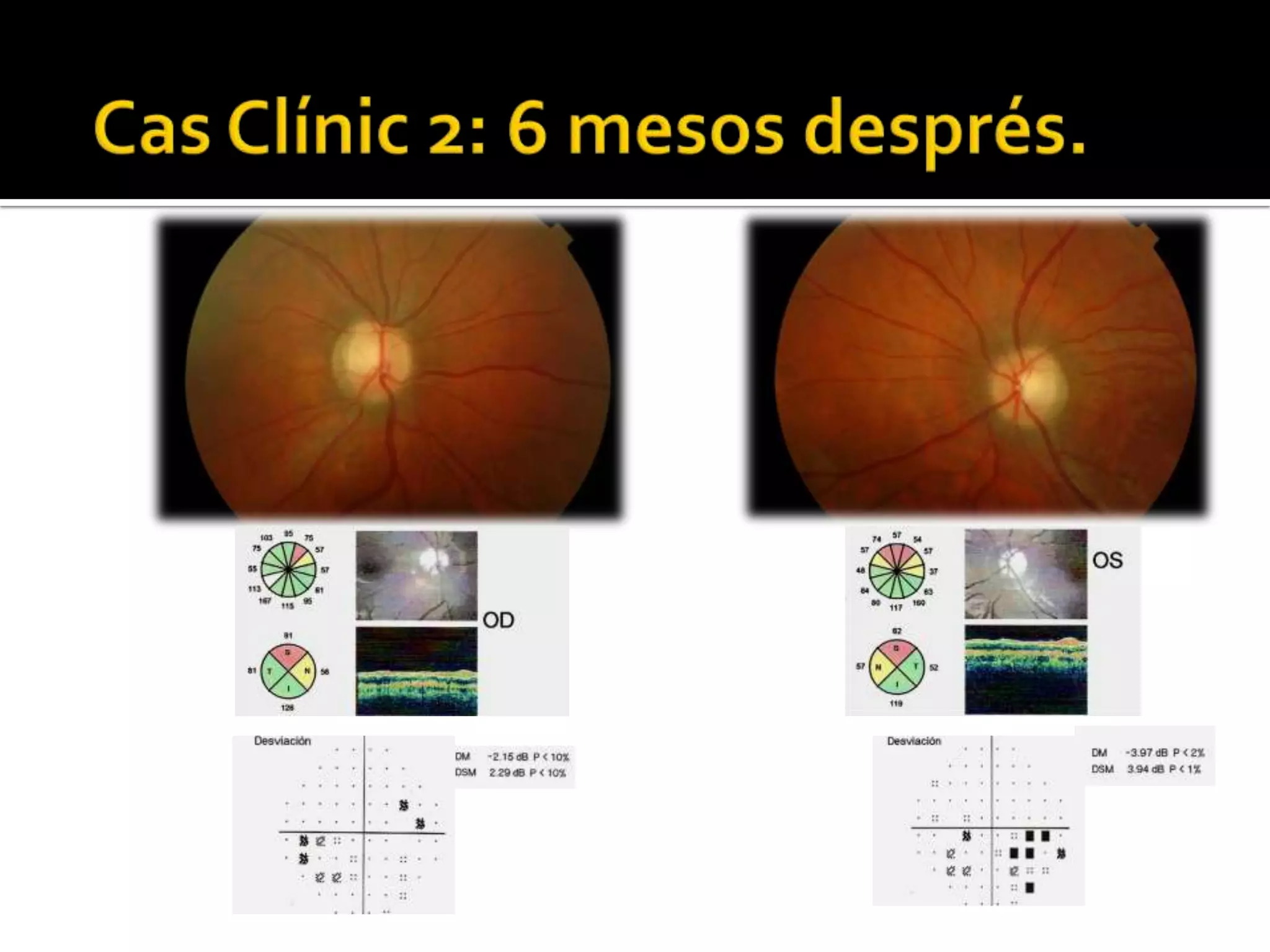 PAPIL·LEDEMA	TractamentOpcions quirúrgiques: