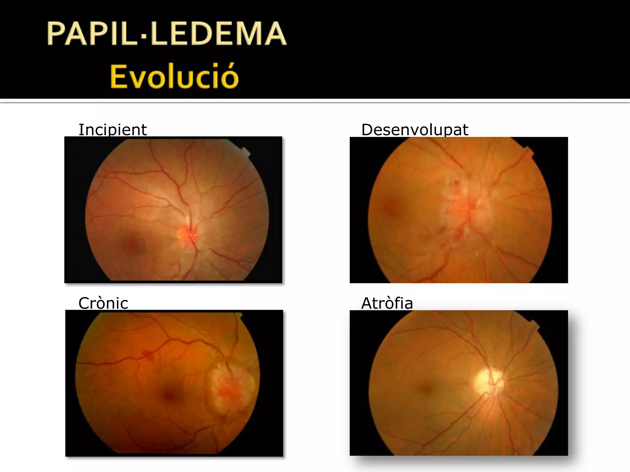 PAPIL·LEDEMA	EvolucióDesenvolupatIncipientCrònicAtròfia