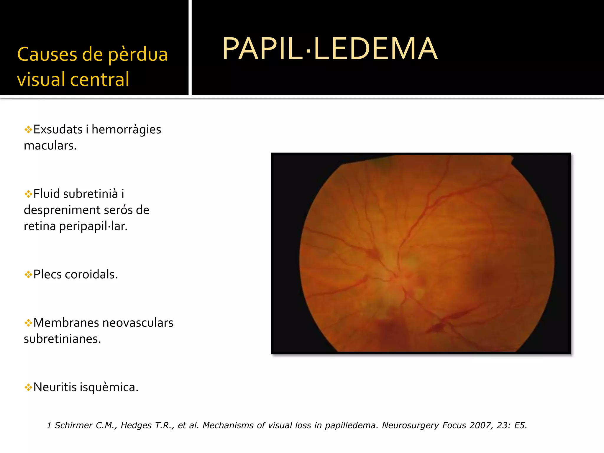 PAPIL·LEDEMACauses de pèrdua visual centralExsudats i hemorràgies maculars.