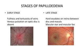 STAGES OF PAPILLOEDEMA
• EARLY STAGE
Fullness and tortuosity of veins
Venous pulsation on optic disc is
absent
• LATE STAGE
Hard exudates on retina between
disc and macula
Macular star and macular fan
 