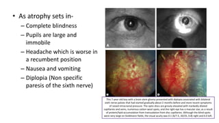 • As atrophy sets in-
– Complete blindness
– Pupils are large and
immobile
– Headache which is worse in
a recumbent position
– Nausea and vomiting
– Diplopia (Non specific
paresis of the sixth nerve)
This 7-year-old boy with a brain stem glioma presented with diplopia associated with bilateral
sixth nerve palsies that had started gradually about 2 months before and more recent symptoms
of raised intracranial pressure. The optic discs are grossly elevated with markedly dilated
capillaries and veins, numerous cotton wool spots, and the right eye has a macular star, as a result
of protein/lipid accumulation from transudation from disc capillaries. Although the blind spots
were very large on Goldmann fields, the visual acuity was 0.1 (6/7.5, 20/25, 0.8) right and 0.0 left.
 