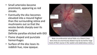 • Small arterioles become
prominent, appearing as red
streaks.
• Eventually the disc becomes
elevated into a mound higher
than the surrounding retina and
mushrooms out so that the
vessles bends sharply over its
margins
Definite parallax elicited with IDO
• Flame shaped and punctate
hemorrhages
• Surface of the disc loses its
reddish hue, now opaque.
Note circumferential retinal folds a.k.a Paton’s lines.
Veins that are enormously dilated may be buried for large
tracts of their course in the swolen and oedematous retina.
 