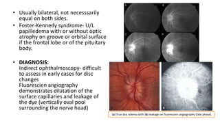 • Usually bilateral, not necesssarily
equal on both sides.
• Foster-Kennedy syndrome- U/L
papilledema with or without optic
atrophy on groove or orbital surface
if the frontal lobe or of the pituitary
body.
• DIAGNOSIS:
Indirect ophthalmoscopy- difficult
to assess in early cases for disc
changes
Fluorescien angiography
demonstrates dilatation of the
surface capillaries and leakage of
the dye (vertically oval pool
surrounding the nerve head)
(a) True disc edema with (b) leakage on fluorescein angiography (late phase).
 