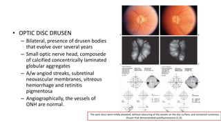 • OPTIC DISC DRUSEN
– Bilateral, presence of drusen bodies
that evolve over several years
– Small optic nerve head, composede
of calcified concentrically laminated
globular aggregates
– A/w angiod streaks, subretinal
neovascular membranes, vitreous
hemorrhage and retinitis
pigmentosa
– Angiographically, the vessels of
ONH are normal.
The optic discs were mildly elevated, without obscuring of the vessels on the disc surface, and contained numerous
drusen that demonstrated autofluorescence (C,D).
 