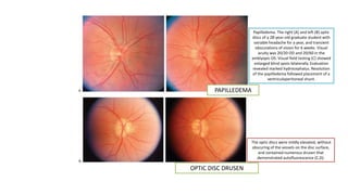 PAPILLEDEMA
OPTIC DISC DRUSEN
Papilledema. The right (A) and left (B) optic
discs of a 28-year-old graduate student with
variable headache for a year, and transient
obscurations of vision for 6 weeks. Visual
acuity was 20/20 OD and 20/60 in the
amblyopic OS. Visual field testing (C) showed
enlarged blind spots bilaterally. Evaluation
revealed marked hydrocephalus. Resolution
of the papilledema followed placement of a
ventriculoperitoneal shunt.
The optic discs were mildly elevated, without
obscuring of the vessels on the disc surface,
and contained numerous drusen that
demonstrated autofluorescence (C,D).
 