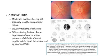 • OPTIC NEURITIS
– Moderate swelling shelving off
gradually into the surrounding
retina.
– Visual symptoms are marked
– Differentiating feature: Acute
depression of central vision,
presence of definite afferent
pupillary defect and the absence of
signs of an ICSOL. Papillitis. The right (A) and left (B) optic discs of a 43-year-old woman who had experienced pain
with movement of the left eye for 2 weeks, and blurred vision of that eye for 1 week. Visual acuity
was 20/20 OD and 20/50 OS. There was a moderate relative afferent pupil defect OS. Visual field
testing (C) showed diffusely reduced sensitivity in the central field of the left eye, especially
nasally. The right optic disc was normal, and the left was mildly swollen. Without treatment, the
patient subsequently had improvement of the visual field abnormality and pupillary sluggishness,
though the visual acuity remained impaired a year later.
 