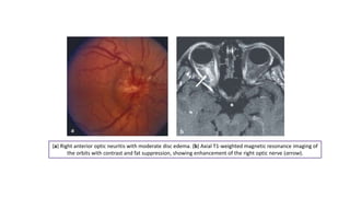 (a) Right anterior optic neuritis with moderate disc edema. (b) Axial T1-weighted magnetic resonance imaging of
the orbits with contrast and fat suppression, showing enhancement of the right optic nerve (arrow).
 